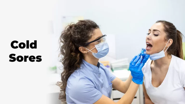 Cold Sores