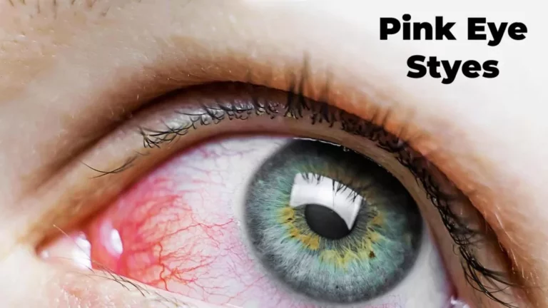 Pink Eye, Styes