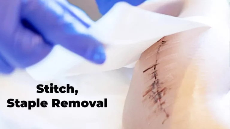 Stitch, Staple Removal
