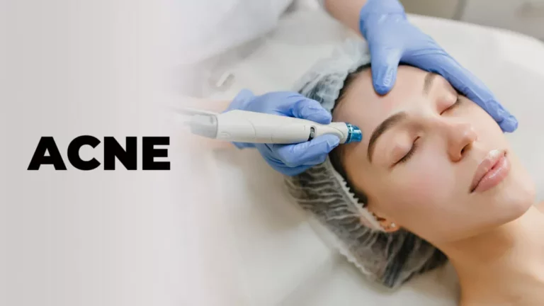 Acne